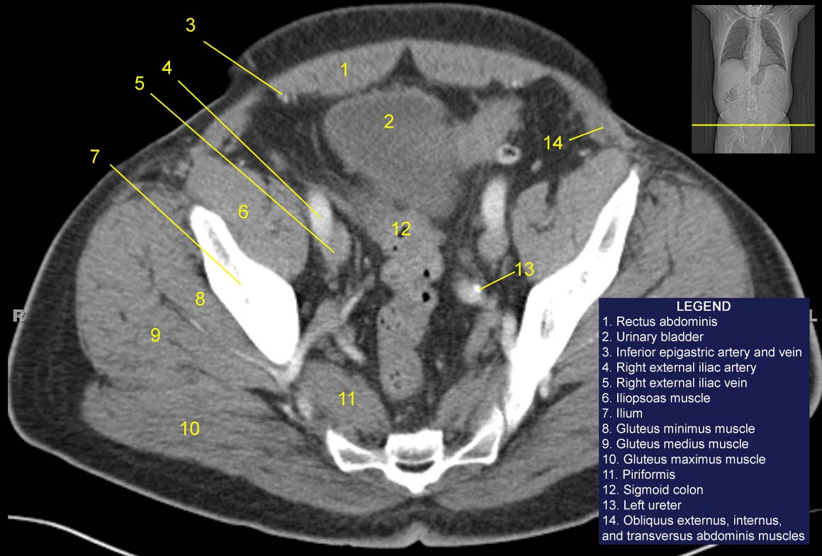 Pelvis computed tomograph (axial CT)