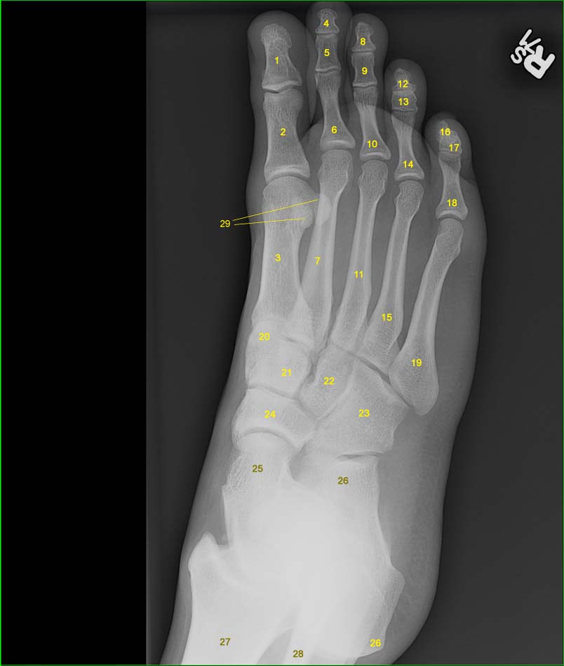 Right foot x-ray (oblique)